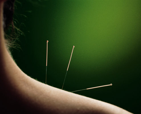 Port Moody Acupuncture